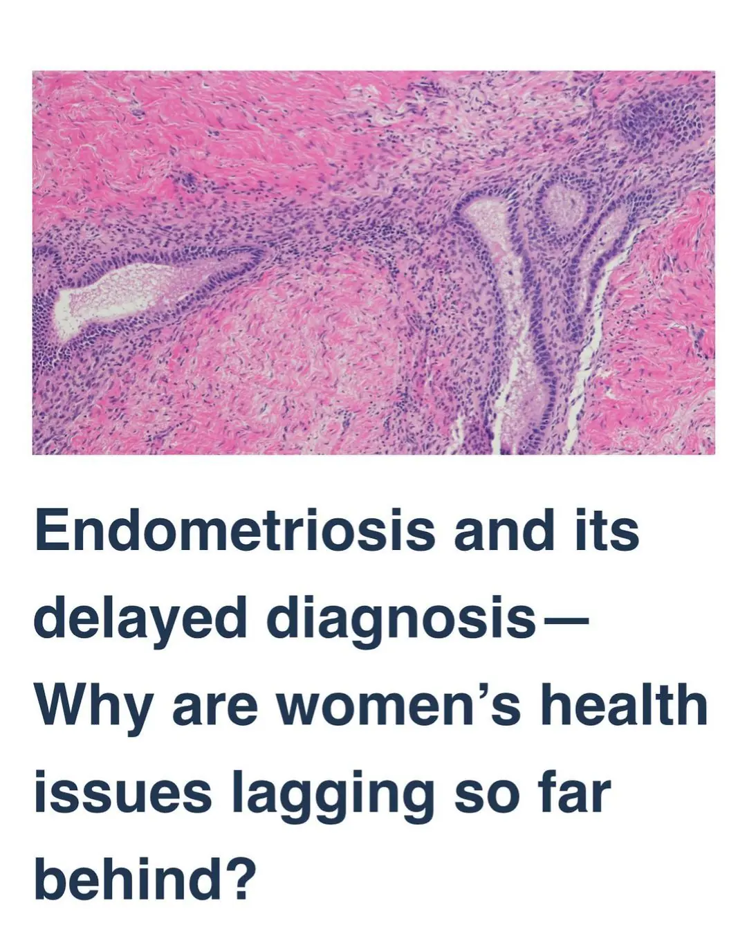 Endometriosis delayed diagnosis